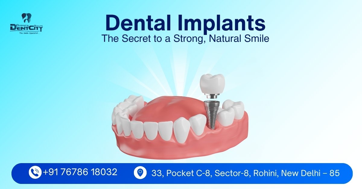 Dental Implants: The Secret to a Strong, Natural Smile
