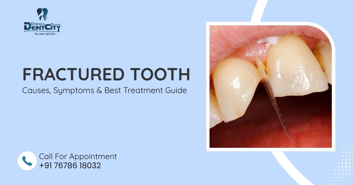 Fractured Tooth: Causes, Symptoms & Best Treatment Guide