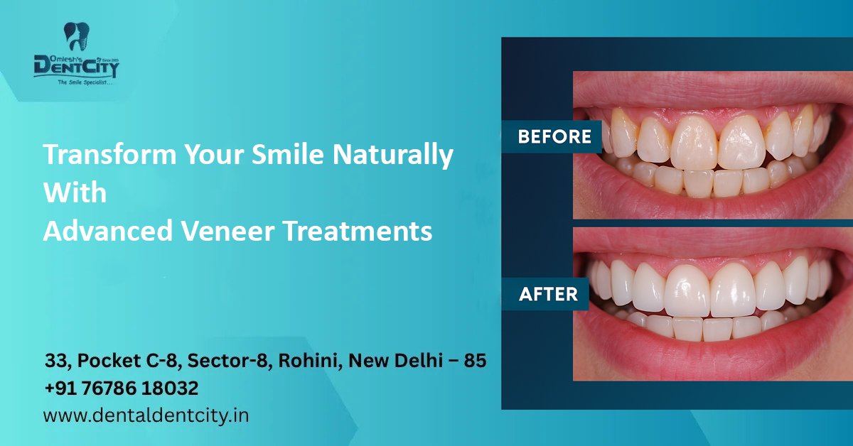 Transform your smile naturally with advanced veneer treatments at Omlesh’s Dentcity