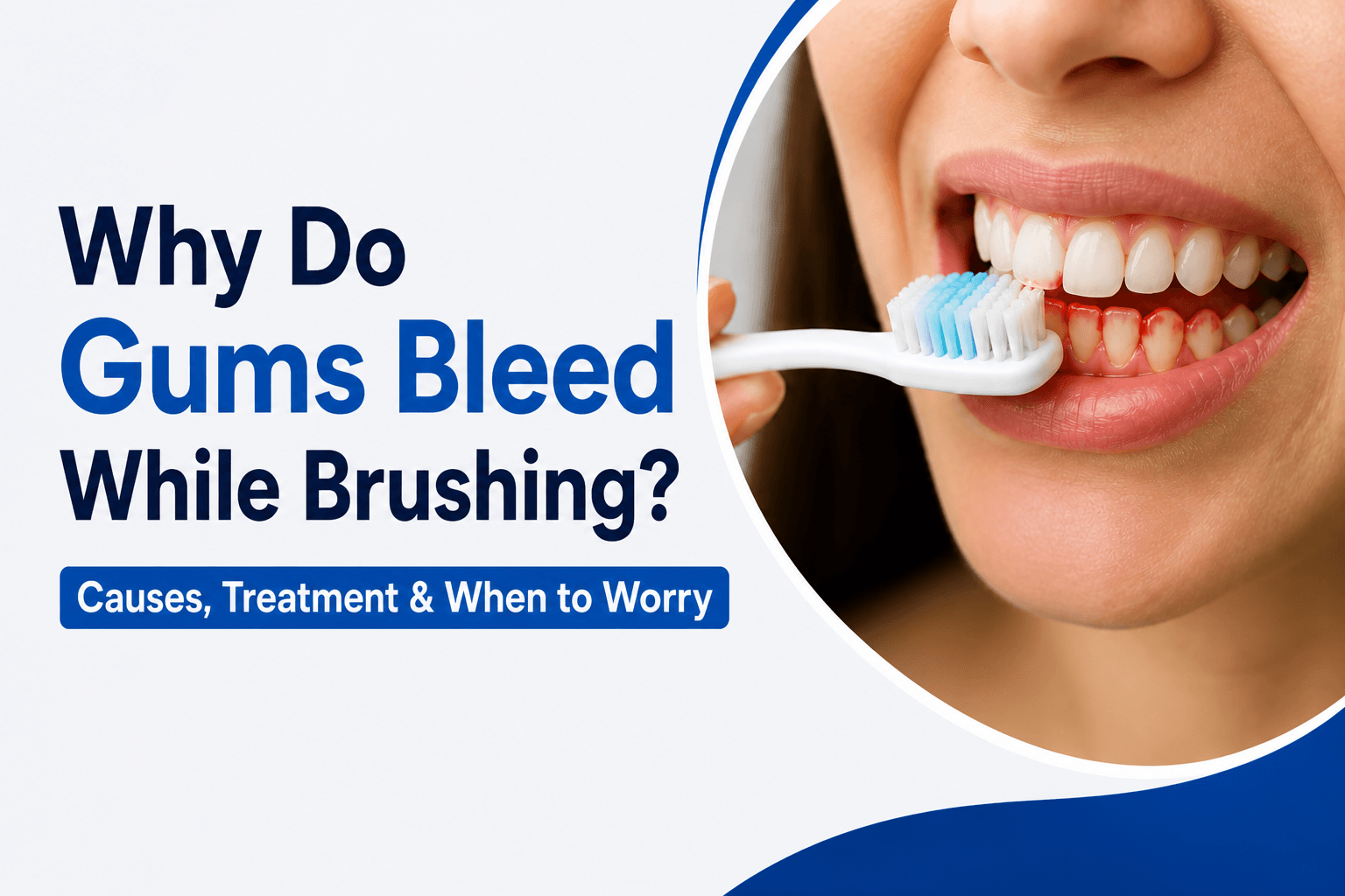 Why Do Gums Bleed While Brushing? Causes, Treatment & When to Worry