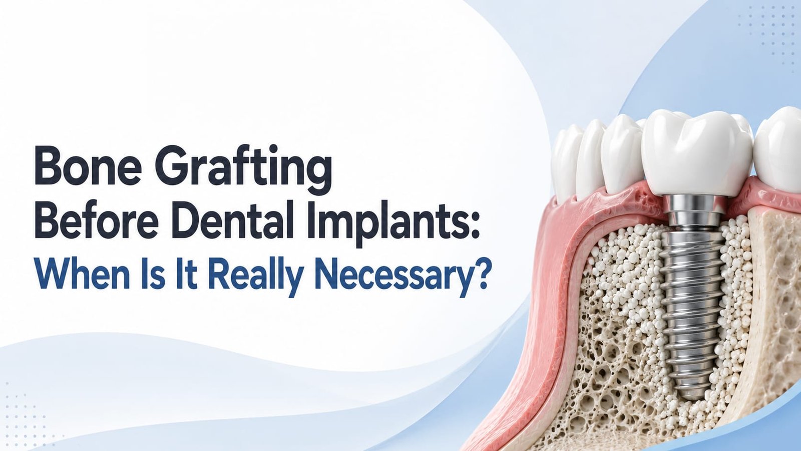 Bone Grafting Before Dental Implants: When Is It Really Necessary?