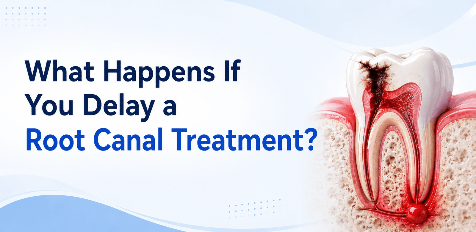 What Happens If You Delay a Root Canal Treatment?