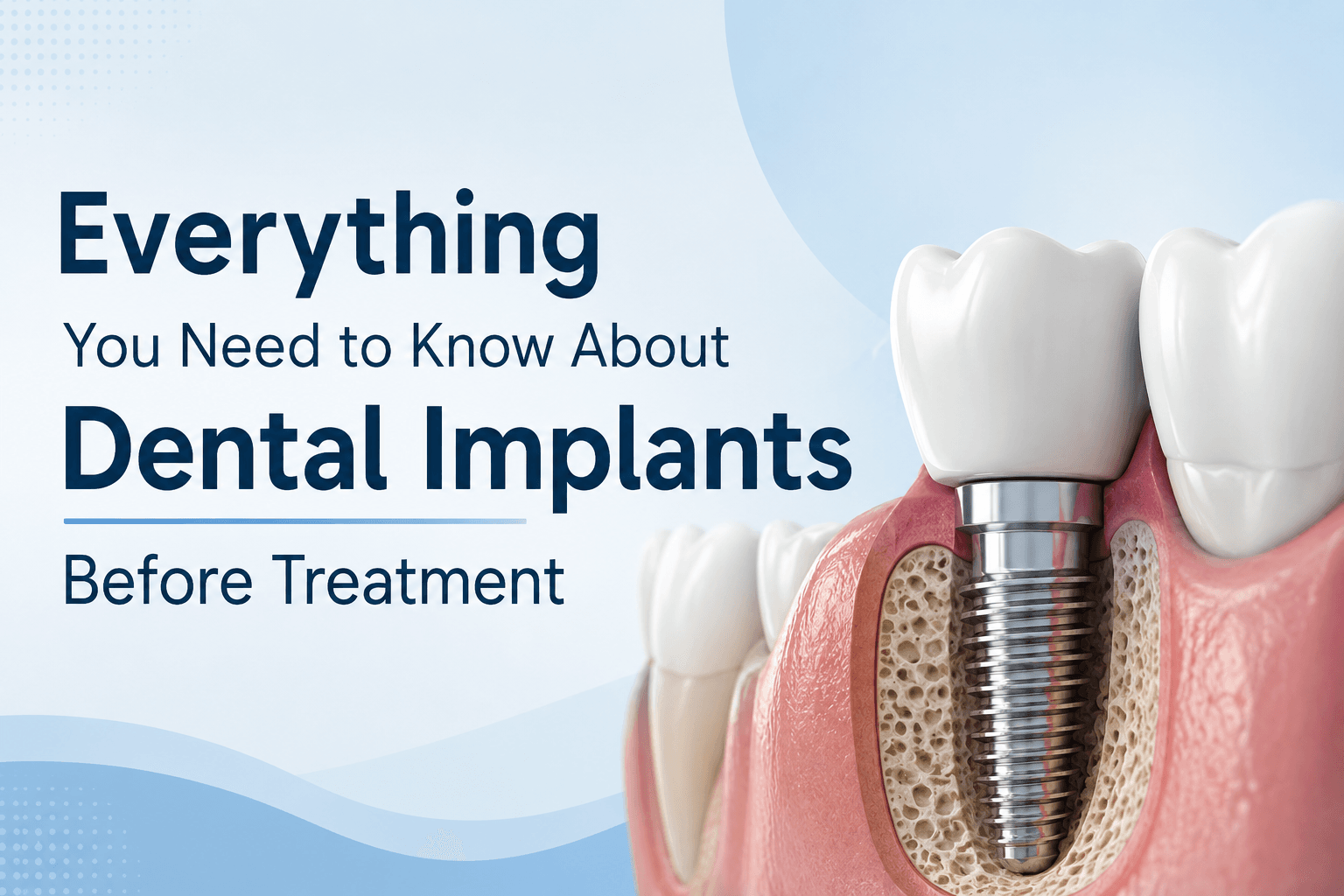 Everything You Need to Know About Dental Implants Before Treatment